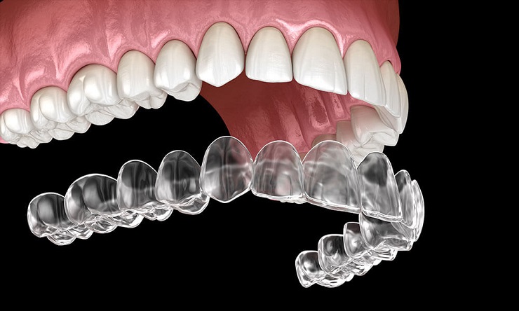 Invisalign