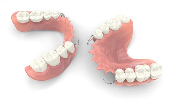 Bridge Prosthesis