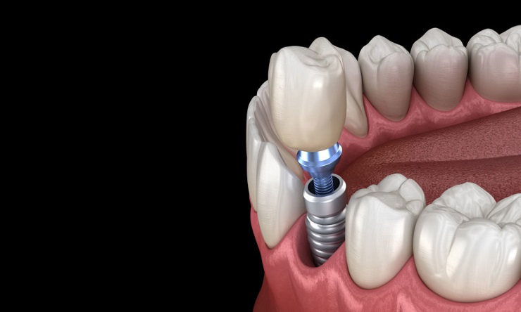 Single Implant