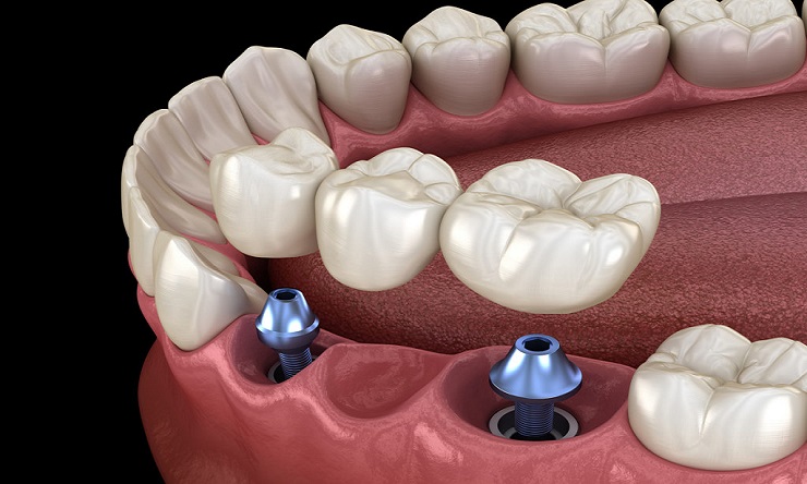Bridge  Dental Implant