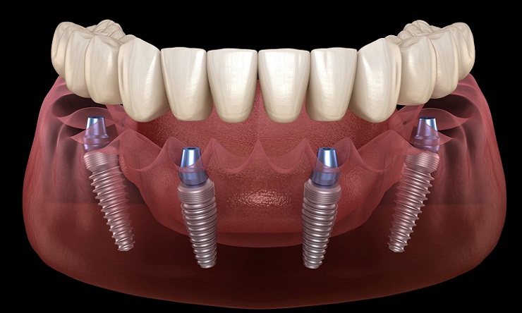 All in 4 Implant