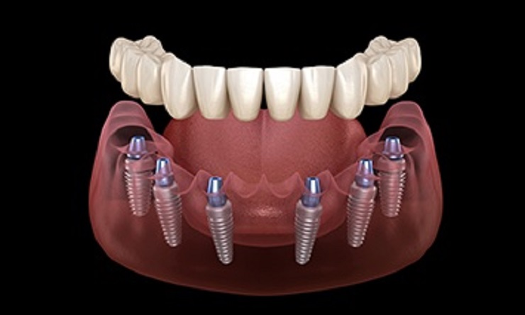 All in 6 implant
